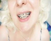 braces fetish: close up video mukbang .. from braces fetish